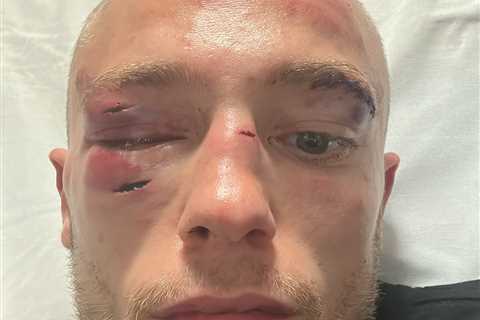 Boxer Sunny Edwards Shows Off Horror Injuries After First Professional Defeat